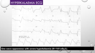 Sine wave appearance with severe hyperkalaemia (K+ 9.9 mEq/L).
HYPERKALAEMIA ECG
 