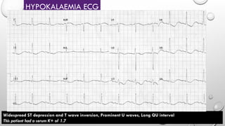HYPOKALAEMIA ECG
Widespread ST depression and T wave inversion, Prominent U waves, Long QU interval
This patient had a serum K+ of 1.7
 