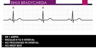 • HR < 60BPM
• REGULAR R TO R INTERVAL
• NO PROLONGED PR INTERVAL
• NO DROP BEAT
SINUS BRADYCARDIA
 