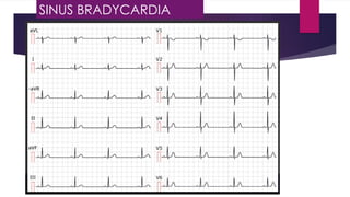 SINUS BRADYCARDIA
 