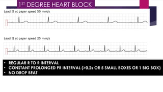 • REGULAR R TO R INTERVAL
• CONSTANT PROLONGED PR INTERVAL (>0.2s OR 5 SMALL BOXES OR 1 BIG BOX)
• NO DROP BEAT
1ST
DEGREE HEART BLOCK
 