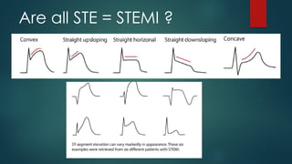 Are all STE = STEMI ?
 