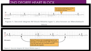 2ND DEGREE HEART BLOCK
 