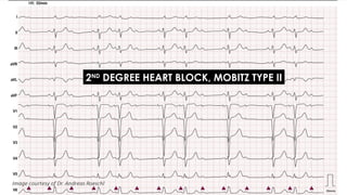 2ND
DEGREE HEART BLOCK, MOBITZ TYPE II
 
