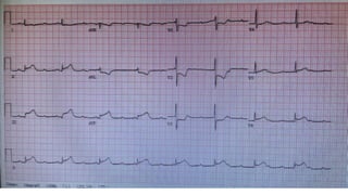 2ND
DEGREE HEART BLOCK, MOBITZ TYPE II
 