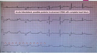 2ND
DEGREE HEART BLOCK, MOBITZ TYPE II
Acute Inferolateral, possible posterior involvement STEMI with complete heart block
 