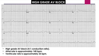 HIGH GRADE AV BLOCK
• High-grade AV block (4:1 conduction ratio).
• Atrial rate is approximately 140 bpm.
• Ventricular rate is approximately 35 bpm.
 