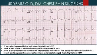40 YEARS OLD, DM, CHEST PAIN SINCE 2HS
• ST elevation is present in the high lateral leads (I and aVL).
• There is also subtle ST elevation with hyperacute T waves in V5-6.
• There is reciprocal ST depression in the inferior leads (III and aVF) with associated ST depression in V1-3
(which could represent anterior ischaemia or reciprocal change). This is high lateral STEMI
 