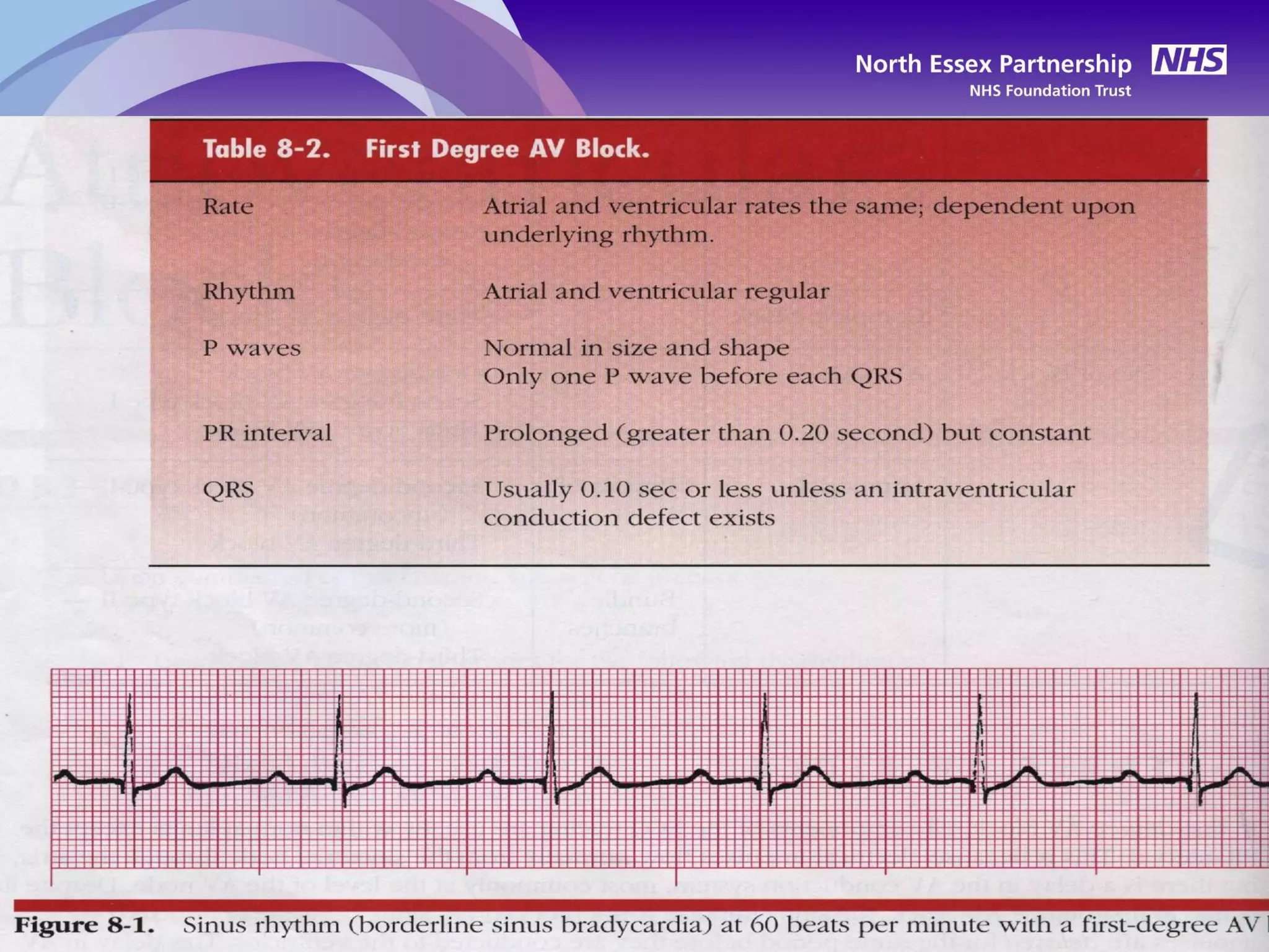 Ecg recording basic interpretation e learning 2 | PPT