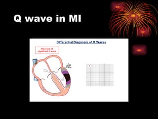 Qm Rouge Wave Ecgrevised2 090808155046 Phpapp01 | PPT