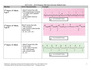 ECG review – ACLS Program Ohio State University Medical Center
Rhythm                            ECG Characteristics                      Example

2nd degree AV Block,              υ More P waves than qRs
Type I                            υ PRI progressively increases
                                    in a cycle until P appears
                                    w/o qRs.
                                  υ Cyclic pattern reoccurs
                                  υR–R≠                                                 = non-conducted P wave




2nd degree AV Block,              More P waves than qRs
                                  υ PRI consistent
Type II
                                  υ qRs normal or wide (bundle
                                  branch block)
                                  υ R - R≠ or R – R =



                                                                                        = non-conducted P wave




3rd degree AV Block               υ More P waves than qRs
                                  υ P not r/t qRs
                                    (P too close, P too far)
                                  υ PRI varies greatly
                                  υ qRs normal or wide
                                  υR–R=
                                                                                        = non-conducted P wave




Published by: Department of Educational Development and Resources, OSU Medical Center                            8
© December 2001 by The Ohio State Univeristy Medical Center All Rights Reserved
 