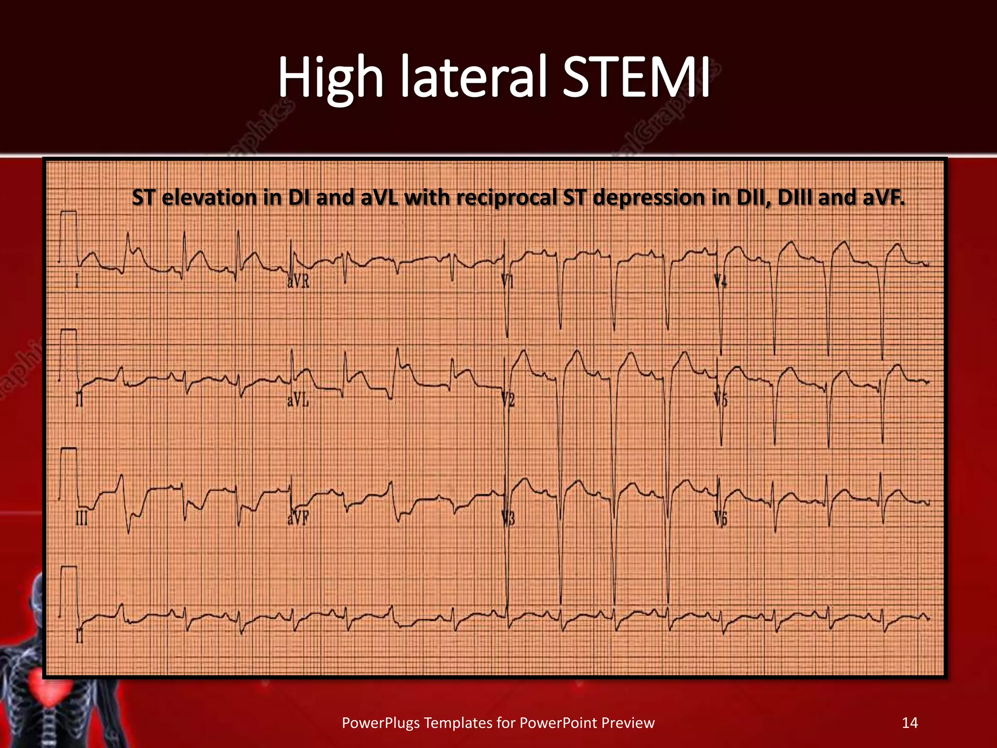 High lateral STEMI
PowerPlugs Templates for PowerPoint Preview 14
ST elevation in DI and aVL with reciprocal ST depression in DII, DIII and aVF.
 