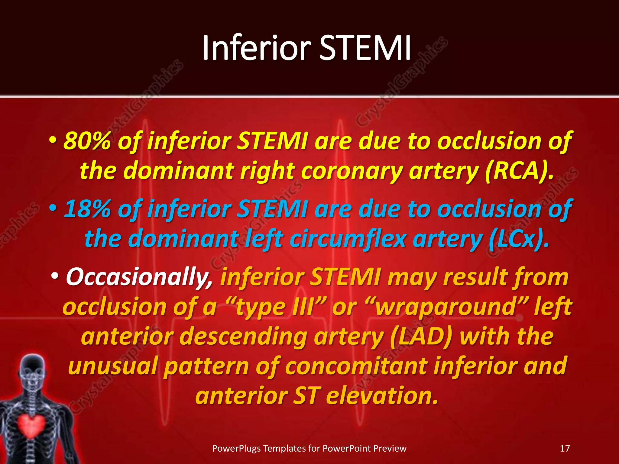 Inferior STEMI
• 80% of inferior STEMI are due to occlusion of
the dominant right coronary artery (RCA).
• 18% of inferior STEMI are due to occlusion of
the dominant left circumflex artery (LCx).
• Occasionally, inferior STEMI may result from
occlusion of a “type III” or “wraparound” left
anterior descending artery (LAD) with the
unusual pattern of concomitant inferior and
anterior ST elevation.
PowerPlugs Templates for PowerPoint Preview 17
 