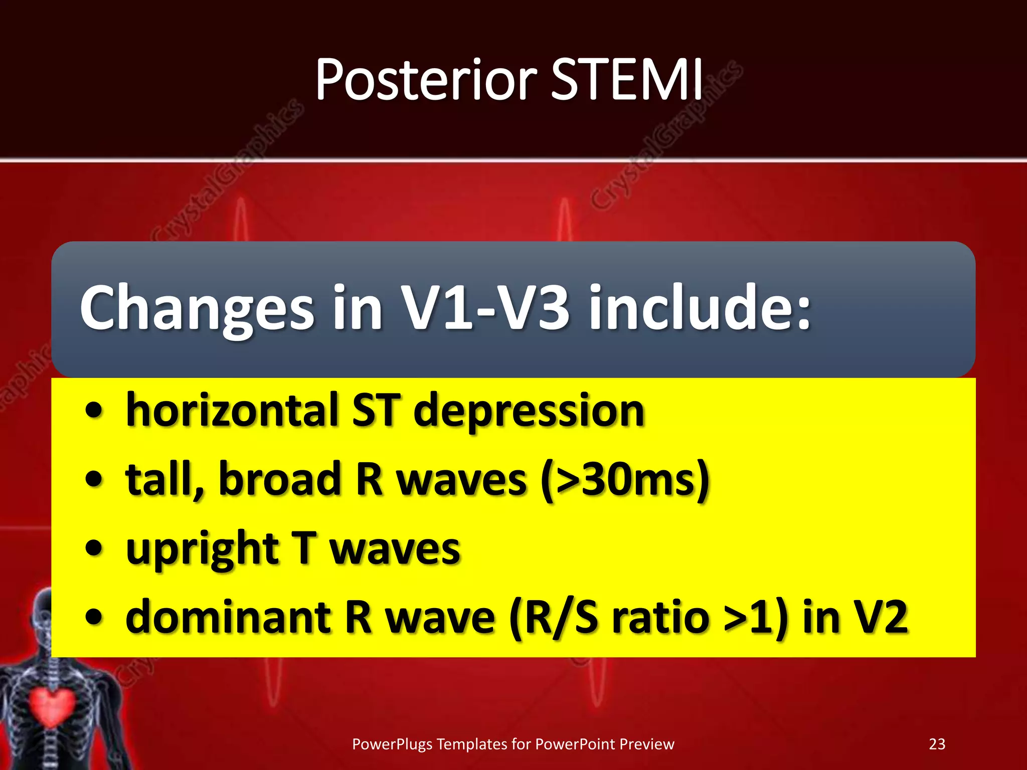 Posterior STEMI
Changes in V1-V3 include:
• horizontal ST depression
• tall, broad R waves (>30ms)
• upright T waves
• dominant R wave (R/S ratio >1) in V2
PowerPlugs Templates for PowerPoint Preview 23
 
