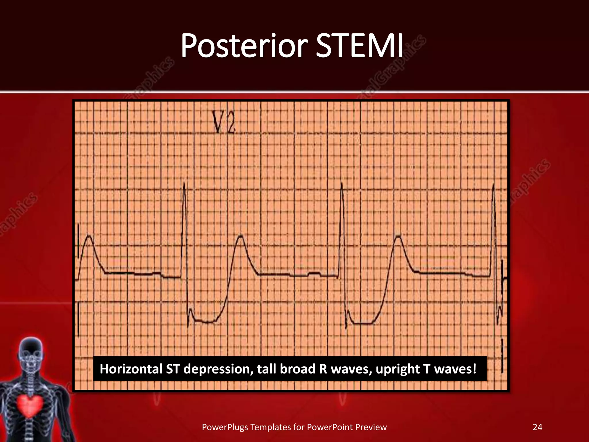 Posterior STEMI
PowerPlugs Templates for PowerPoint Preview 24
Horizontal ST depression, tall broad R waves, upright T waves!
 