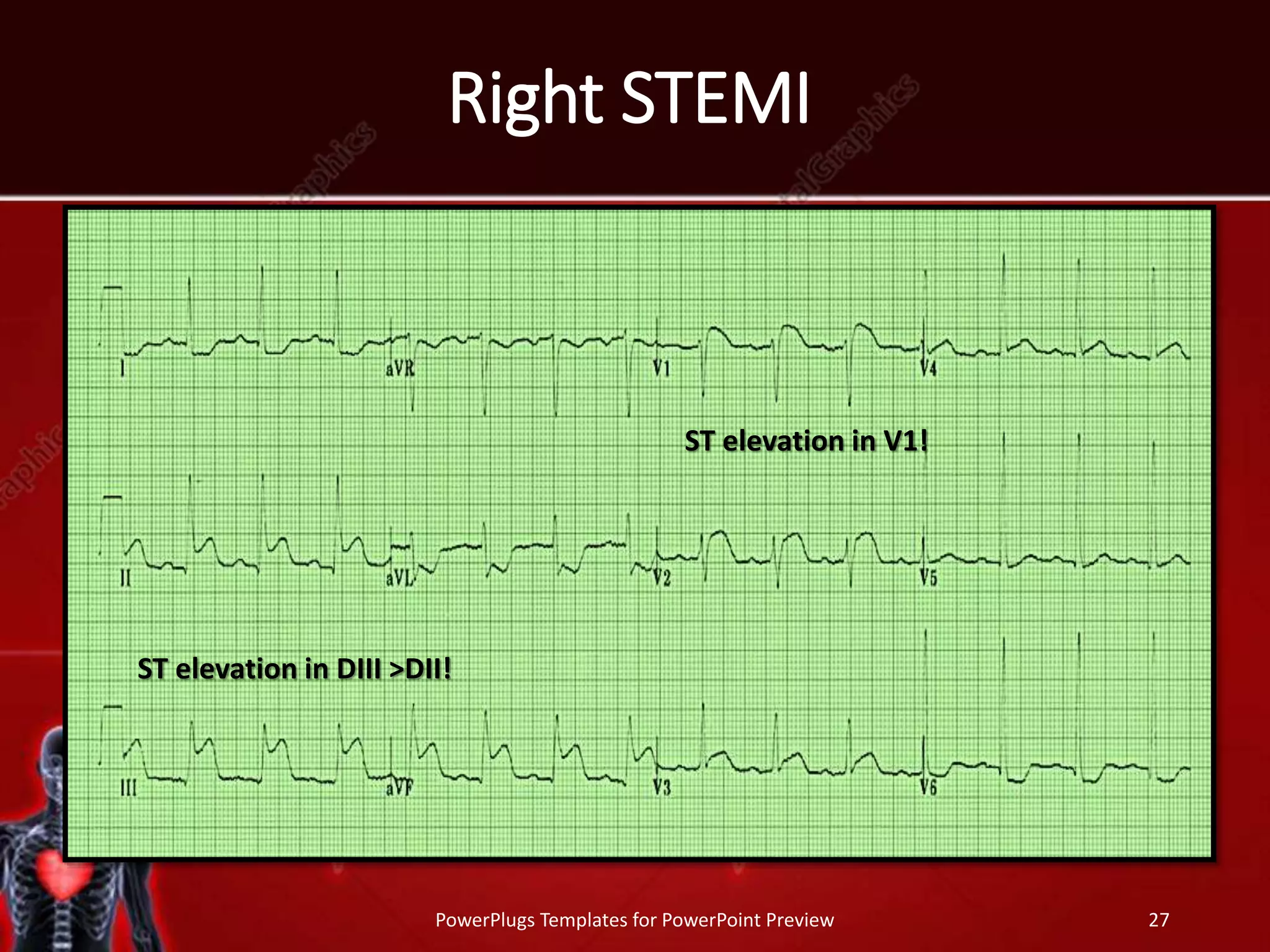 Right STEMI
PowerPlugs Templates for PowerPoint Preview 27
ST elevation in DIII >DII!
ST elevation in V1!
 