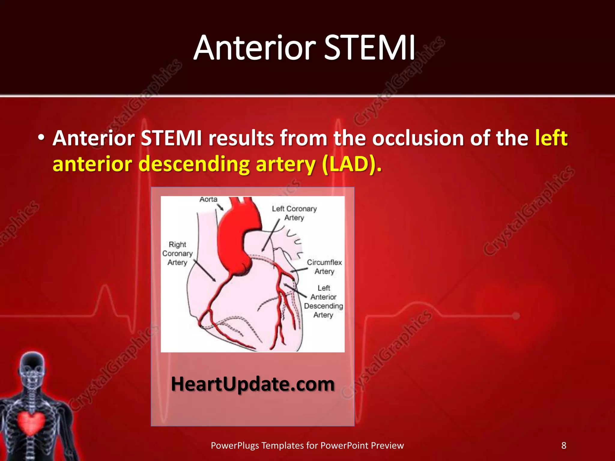 Anterior STEMI
• Anterior STEMI results from the occlusion of the left
anterior descending artery (LAD).
PowerPlugs Templates for PowerPoint Preview 8
HeartUpdate.com
 