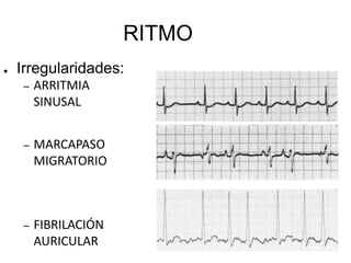 Taquicardia. Frecuencia < 100 / mín.