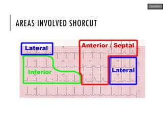 AREAS INVOLVED SHORCUT
ECG MADE EASY
 