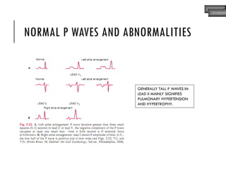 NORMAL P WAVES AND ABNORMALITIES
GENERALLY TALL P WAVES IN
LEAD II MAINLY SIGNIFIES
PULMONARY HYPERTENSION
AND HYPERTROPHY.
ECG MADE EASY
ECG MADE EASY
 