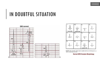 IN DOUBTFUL SITUATION
ECG MADE EASY
 