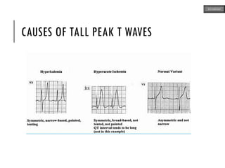 CAUSES OF TALL PEAK T WAVES
ECG MADE EASY
 