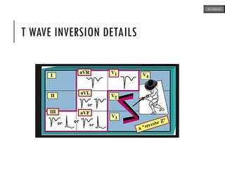 T WAVE INVERSION DETAILS
ECG MADE EASY
 