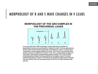MORPHOLOGY OF R AND S WAVE CHANGES IN V LEADS
ECG MADE EASY
 