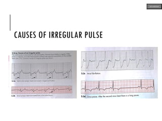 CAUSES OF IRREGULAR PULSE
ECG MADE EASY
 