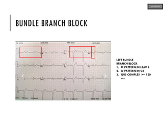 BUNDLE BRANCH BLOCK
LEFT BUNDLE
BRANCH BLOCK
1. M PATTERN IN LEAD I
2. W PATTERN IN V4
3. QRS COMPLEX >= 120
ms
ECG MADE EASY
 