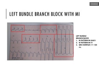 LEFT BUNDLE BRANCH BLOCK WITH MI
LEFT BUNDLE
BRANCH BLOCK
1. M PATTERN IN LEAD I
2. W PATTERN IN V1
3. QRS COMPLEX >= 120
ms
ECG MADE EASY
 