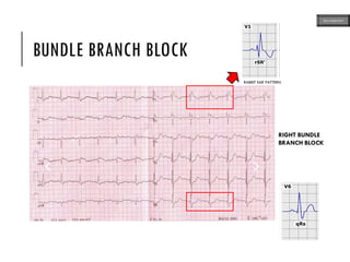 BUNDLE BRANCH BLOCK
RIGHT BUNDLE
BRANCH BLOCK
RABBIT EAR PATTERN
ECG MADE EASY
 