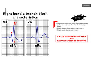 r
S
R’
DOUBT
r
S
R’
R WAVE CANNOT BE NEGATIVE
AND
Q WAVE CANNOT BE POSITIVE
ECG MADE EASY
 