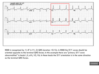 RBBB is recognized by 1) rR' in V1; 2) QRS duration >0.12s. In RBBB the ST-T waves should be
oriented opposite to the terminal QRS forces. In this example there are "primary ST-T wave
abnormalities" in leads I, II, aVL, V5, V6. In these leads the ST-T orientation is in the same direction
as the terminal QRS forces.
ECG MADE EASY
 