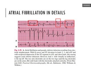 ATRIAL FIBRILLATION IN DETAILS
ECG MADE EASY
 