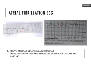 ATRIAL FIBRILLATION ECG
1. THE VENTRICULAR COMPLEXES ARE IRREGULAR
2. THERE ARE NO P WAVES AND IRREGULAR OSCILLATIONS DISTUREB THE
BASELINE.
ECG MADE EASY
 