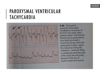 PAROXYSMAL VENTRICULAR
TACHYCARDIA
ECG MADE EASY
 