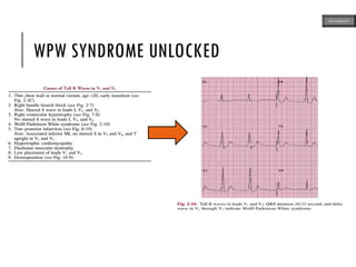 WPW SYNDROME UNLOCKED
ECG MADE EASY
 