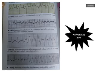 ABNORMAL
ECG
ECG MADE EASY
 