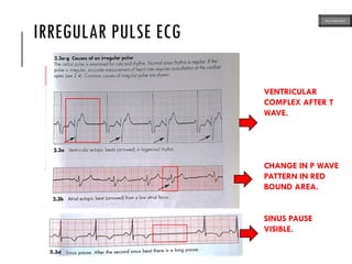 IRREGULAR PULSE ECG
VENTRICULAR
COMPLEX AFTER T
WAVE.
CHANGE IN P WAVE
PATTERN IN RED
BOUND AREA.
SINUS PAUSE
VISIBLE.
ECG MADE EASY
 