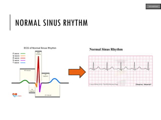 NORMAL SINUS RHYTHM
ECG MADE EASY
 