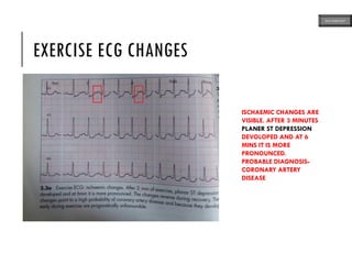 EXERCISE ECG CHANGES
ISCHAEMIC CHANGES ARE
VISIBLE. AFTER 3 MINUTES
PLANER ST DEPRESSION
DEVOLOPED AND AT 6
MINS IT IS MORE
PRONOUNCED.
PROBABLE DIAGNOSIS-
CORONARY ARTERY
DISEASE
ECG MADE EASY
 
