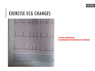 EXERCISE ECG CHANGES
J POINT DEPRESSION
ST DEPRESSION PROVOKED BY EXERCISE
ECG MADE EASY
 