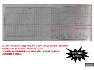 QQQQQQQQQQQQQQQQQQQQQQQQQQQQ
QQQQQQQQQQQQQQQQQQQQQQQQQQQQ
QQQQQQQQQQQQQQQQQQQQQQQQQQQQ
QQQQQQQQQQQQQQQQQQQQQQQQQQ
PATIENT WITH UNSTABLE ANGINA SHOWS PROFOUND ST SEGMENT
DEPRESSION EXTENDING FROM V3 TO V6
ST DEPRESSION GENERALLY INDICATES URGENT CARDIAC
CATHETERIZATION. UNSTABLE
ANGINA
ECG MADE EASY
 