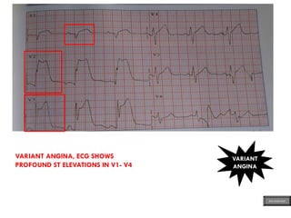 VARIANT
ANGINA
VARIANT ANGINA, ECG SHOWS
PROFOUND ST ELEVATIONS IN V1- V4
ECG MADE EASY
 