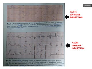 ACUTE
ANTERIOR
INFARCTION
ACUTE
INFERIOR
INFARCTION
ECG MADE EASY
 