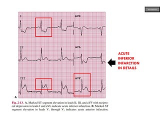 ACUTE
INFERIOR
INFARCTION
IN DETAILS
ECG MADE EASY
 