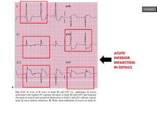 ACUTE
INFERIOR
INFARCTION
IN DETAILS
ECG MADE EASY
 