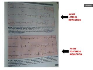 ACUTE
LATERAL
INFARCTION
ACUTE
POSTERIOR
INFARCTION
ECG MADE EASY
 