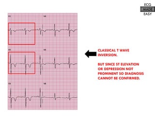CLASSICAL T WAVE
INVERSION.
BUT SINCE ST ELEVATION
OR DEPRESSION NOT
PROMINENT SO DIAGNOSIS
CANNOT BE CONFIRMED.
ECG
MADE
EASY
 